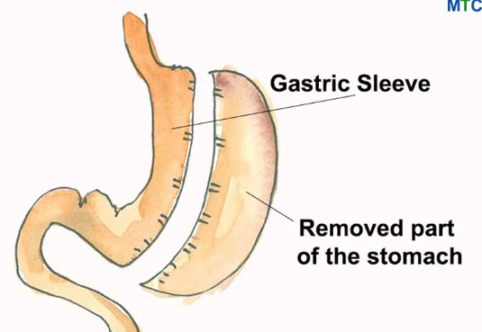 Gastric Sleeve in Mexico: A Transformative Experience post thumbnail image