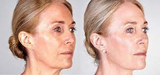 The Art of Skin Revitalization: Nearby Tightening Facial Experts post thumbnail image